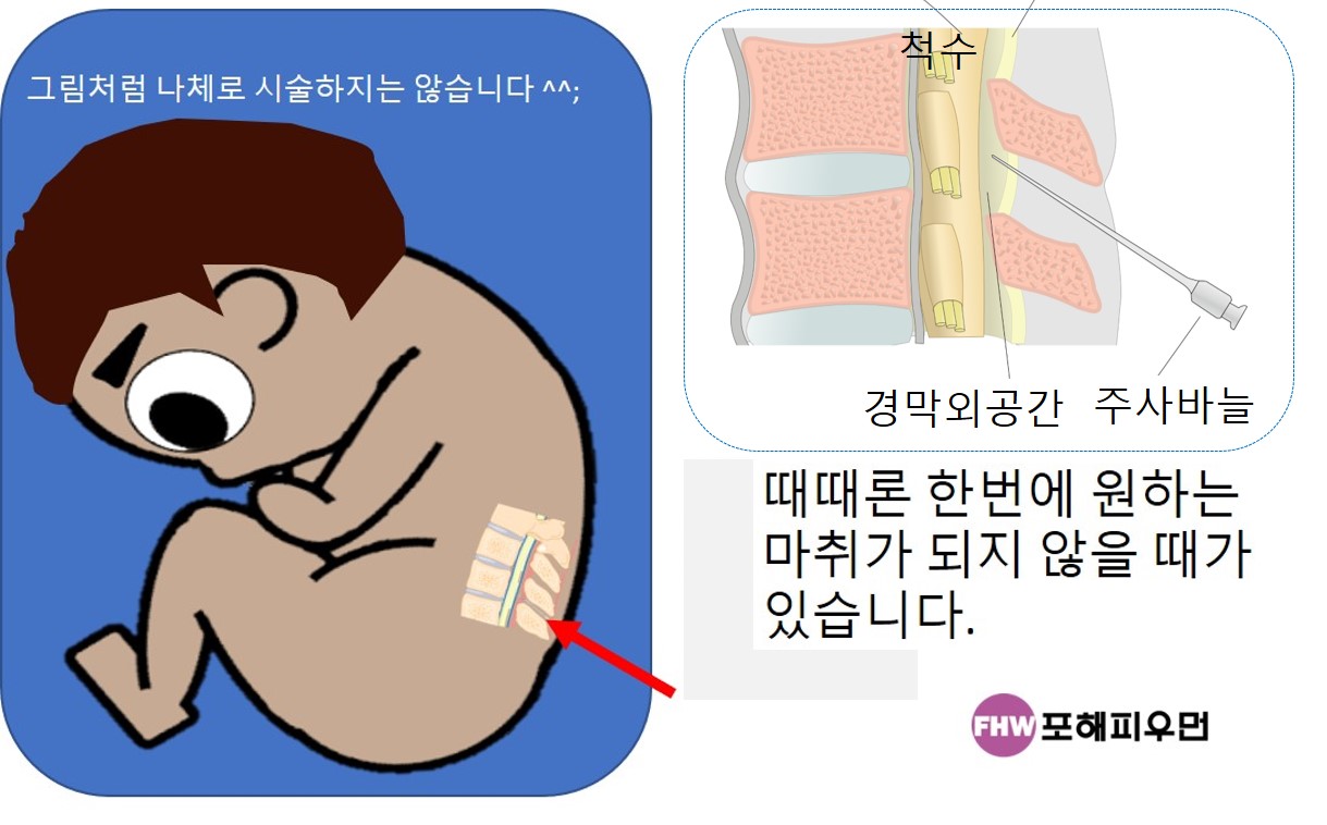 임신준비-무통분만-그림3.jpg